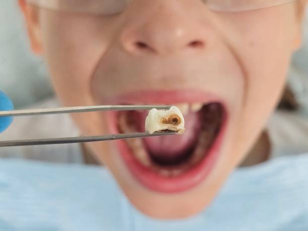 Best Root Canal Emergency Dentist  in Crowley, LA