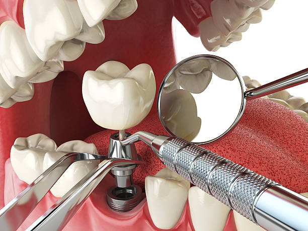 Best Dentist for Tooth Abscess  in Crowley, LA